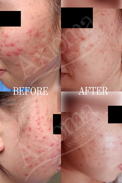 Acne/Blemishes Solution Travel Set